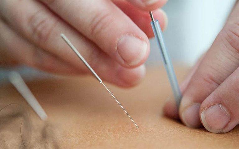 Acupuntura é uma tecnologia que faz parte dos recursos terapêuticos da medicina tradicional chinesa