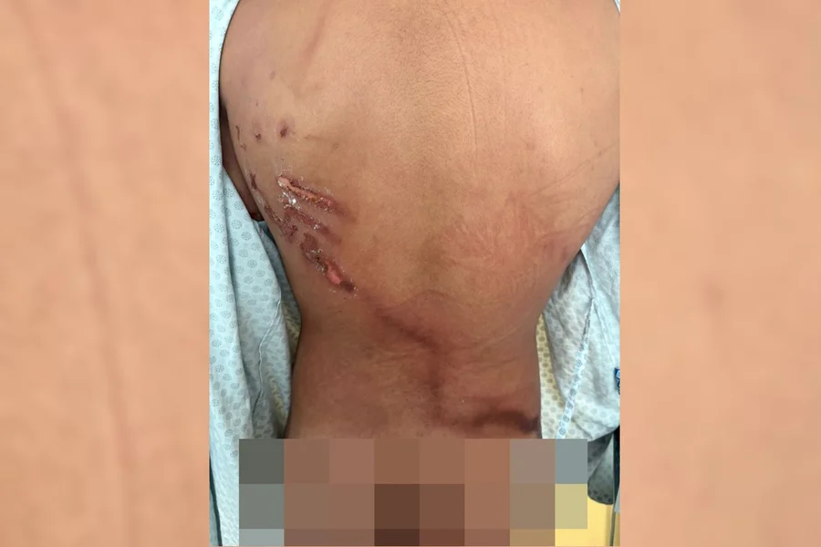Adolescente de 17 anos teve vários ferimentos nas costas