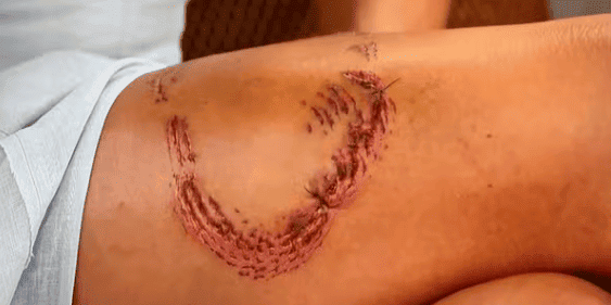 A advogada Tayane Dalazen foi mordida por um tubarão-lixa durante um mergulho em Fernando de Noronha