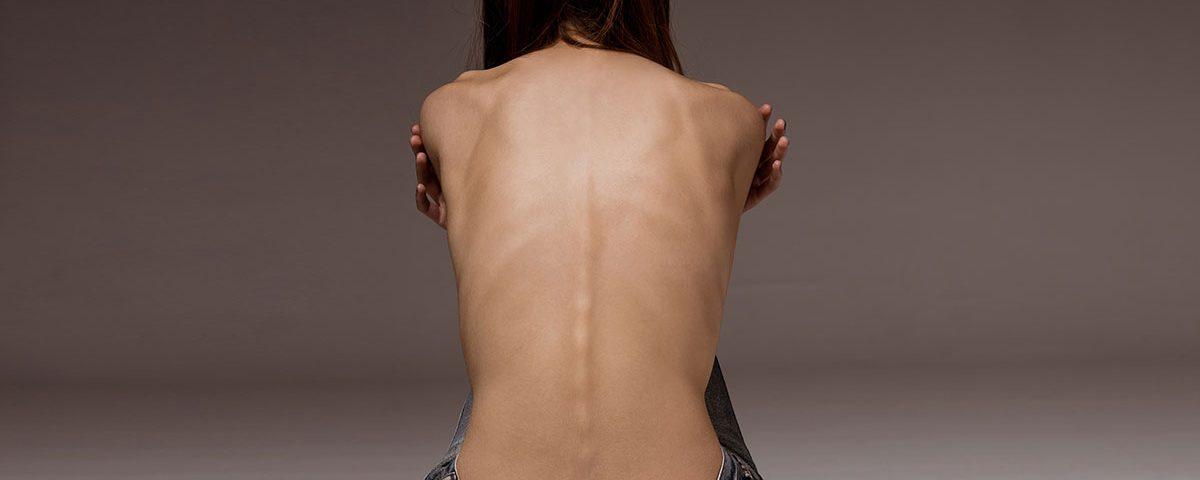 Anorexia