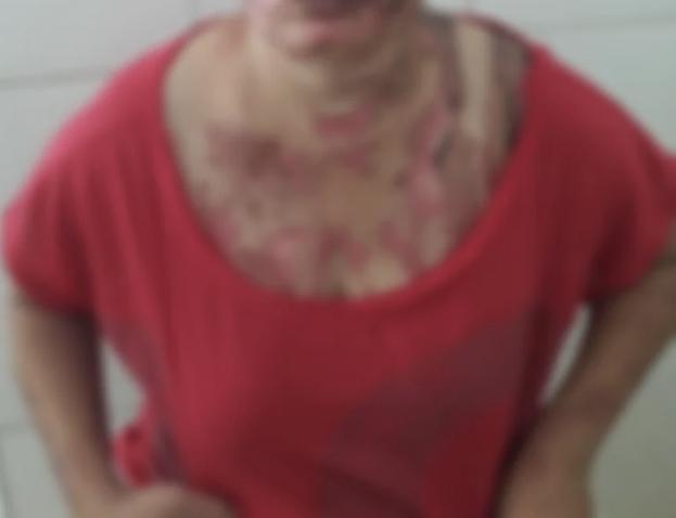 Vítima ficou com o corpo parcialmente queimado