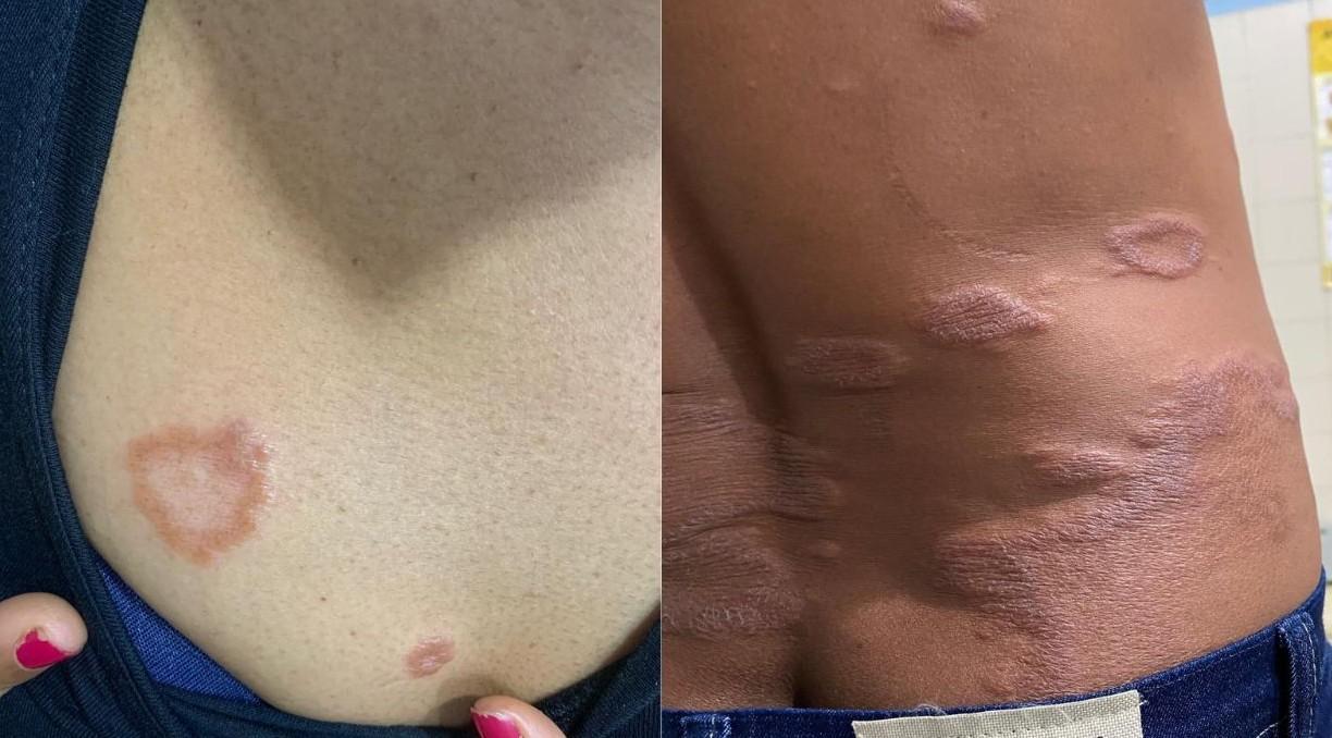 Especialistas alertam para a importância do diagnóstico precoce da hanseníase no Piauí, estado que segue com índices hiperendêmicos da doença