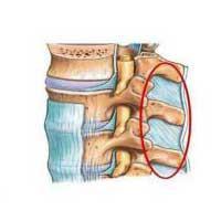 Edema