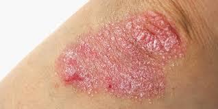Psoriase