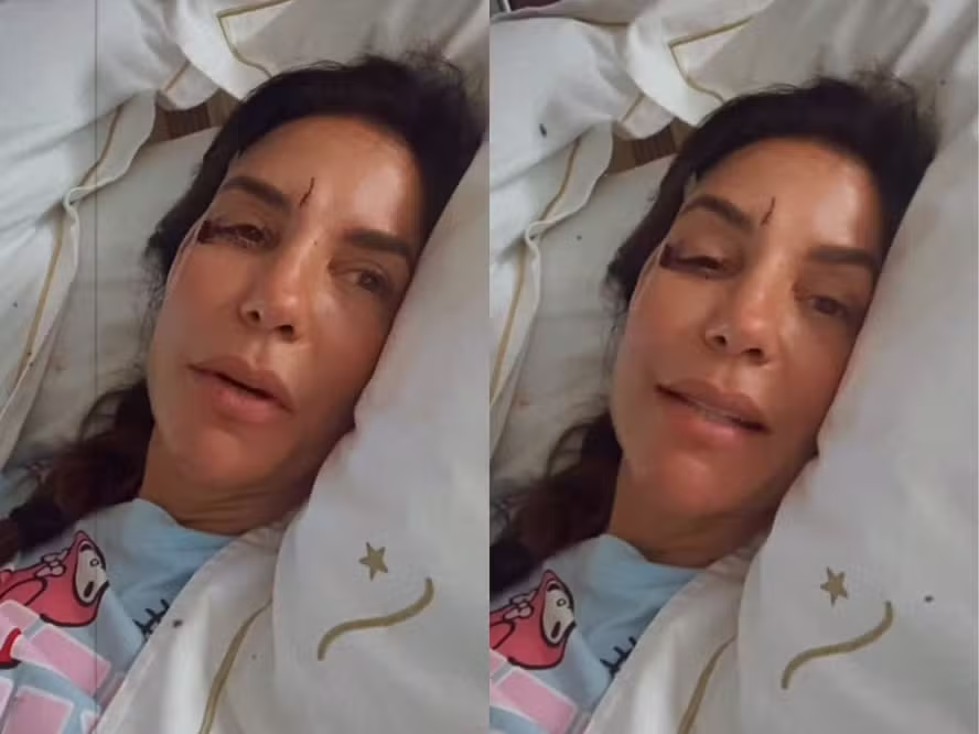 Ivete Sangalo é internada após desmaio e virose; cantora apareceu com rosto machucado