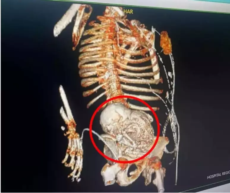 A litopedia é uma condição raríssima; “bebê de pedra” resultante pode não ser detectado por décadas