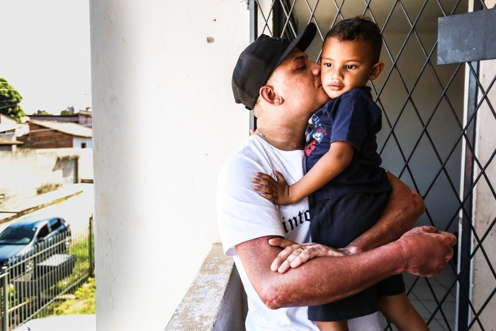 Bruno teve o corpo quase todo queimado durante uma explosão em apartamento