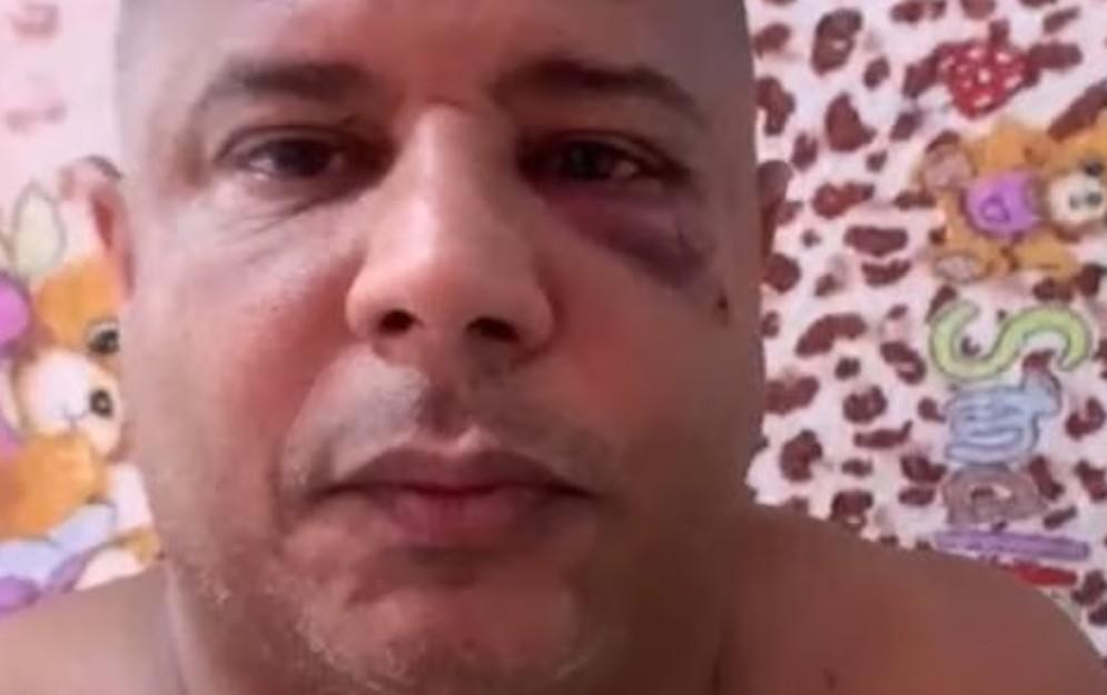 Marcelino reaparece com olho roxo e diz que foi sequestrado