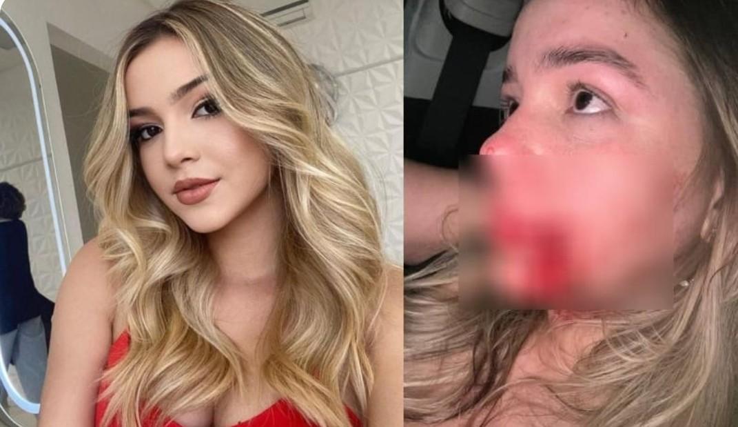 Rosto de Mariana ficou deformado com o soco