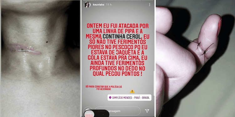 Mulher tem pescoço cortado por linha de cerol e desabafa