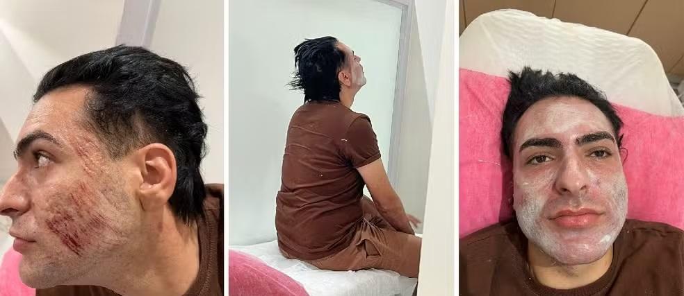 Henrique Chagas ficou com ferimentos no rosto após peeling de fenol