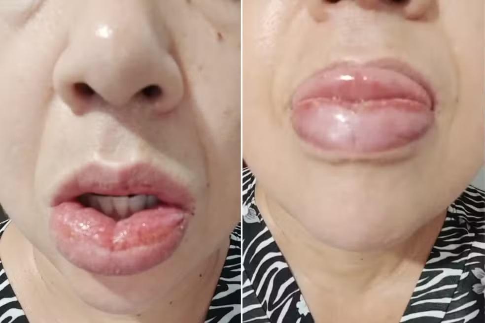 Educadora social, de 45 anos, sofreu reação alérgica após uso de pasta de dente da Colgate