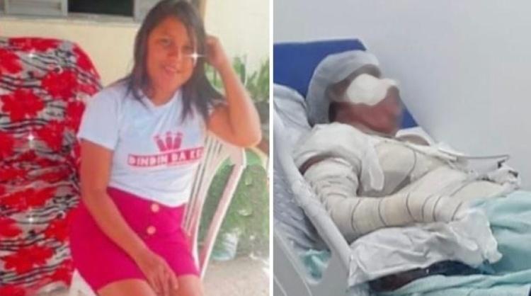 Mulher sofre graves queimaduras ao utilizar álcool para cozinhar